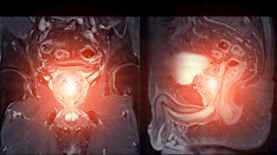 ערמונית מוגדלת, צילום: Shutterstock